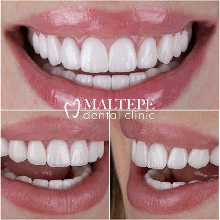 Alana Haim's Perfect Smile: Transforming Teeth Into A Starry Delight