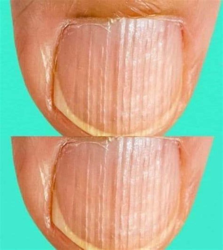 Beau's Lines: Uncover The Meaning Of Horizontal Nail Ridges