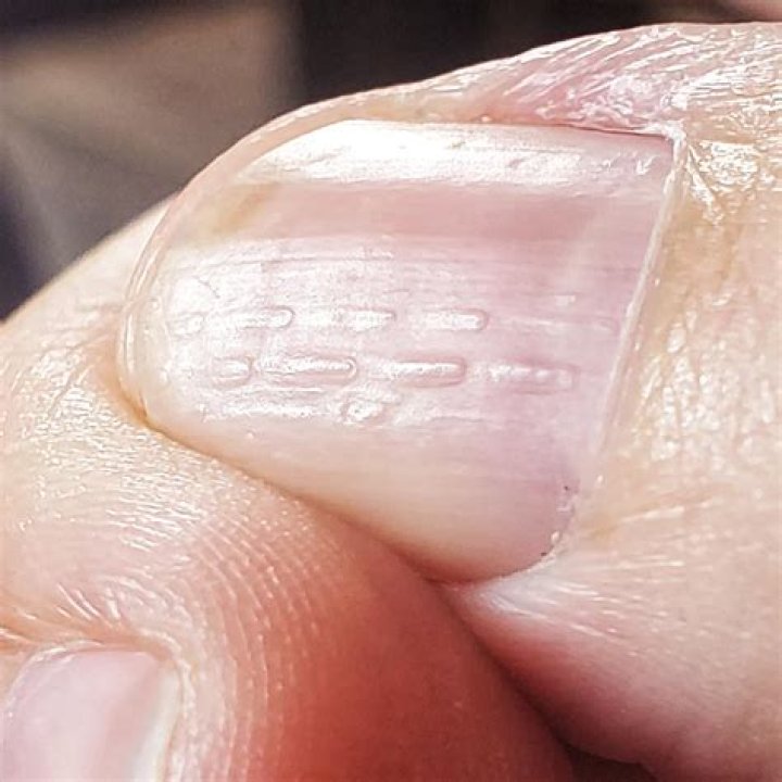 Discover The Meaning Behind Horizontal Nail Ridges: A Guide To Nail Health