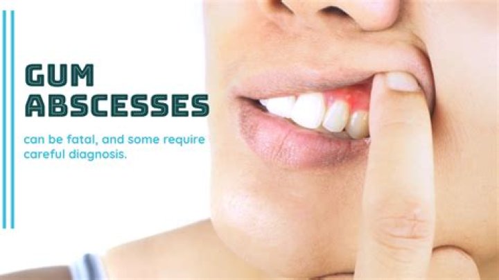 Don't Ignore Gum Abscess! Get Relief Now