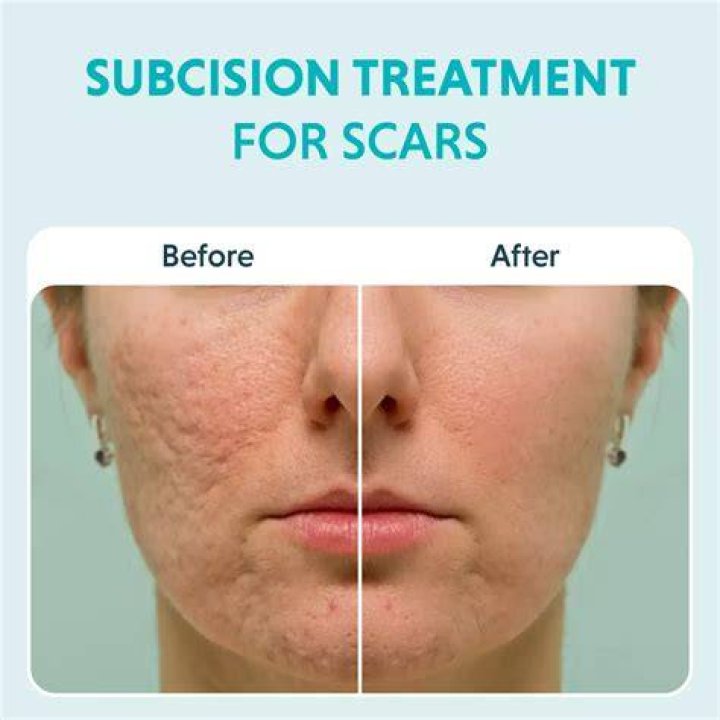 Effective Cover-Up: Eliminating Seal Scars On The Face