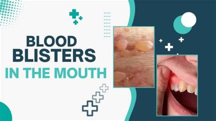Find Relief: Blood Blister On Roof Of Mouth Causes And Treatment