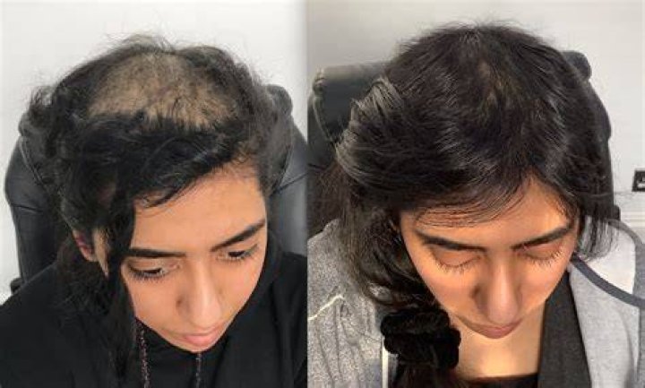 Jordan Walsh Bald: Astonishing Hair Loss Journey Of The Rising Star