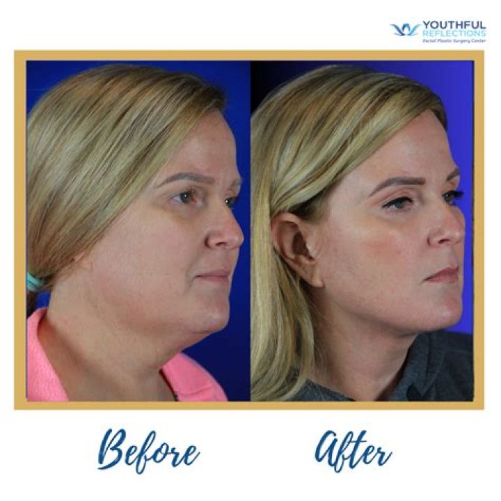 Joyce Meyer's Facial Surgery: A Transformation Revealed