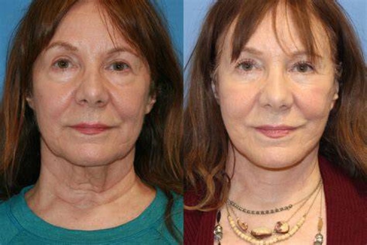 Joyce Meyer's Plastic Surgery: Before And After Transformation