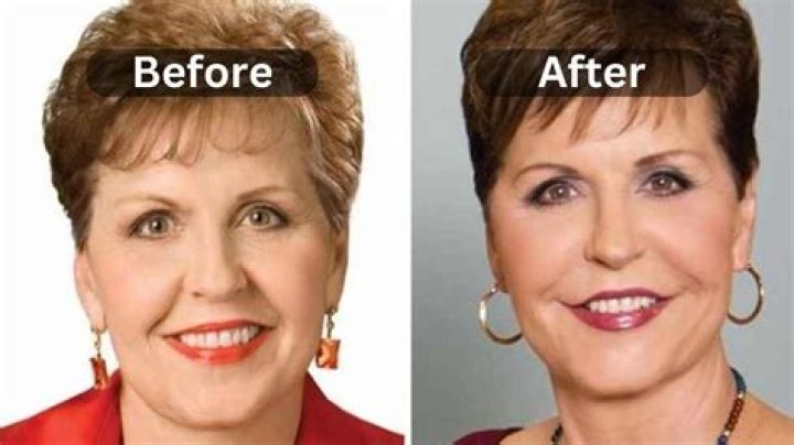 Joyce Meyer's Plastic Surgery Transformation: Before And After Revealed