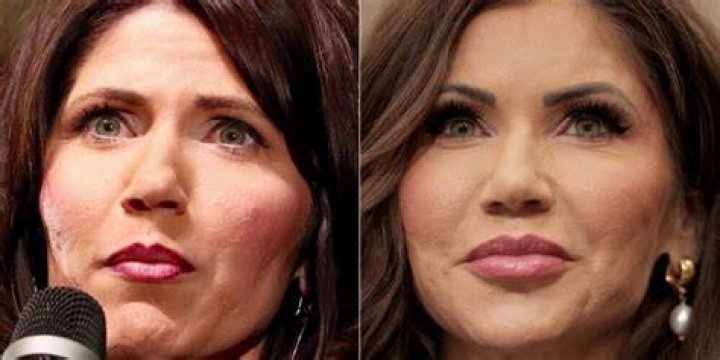 Kristi Noem's Plastic Surgery: Before And After Analysis