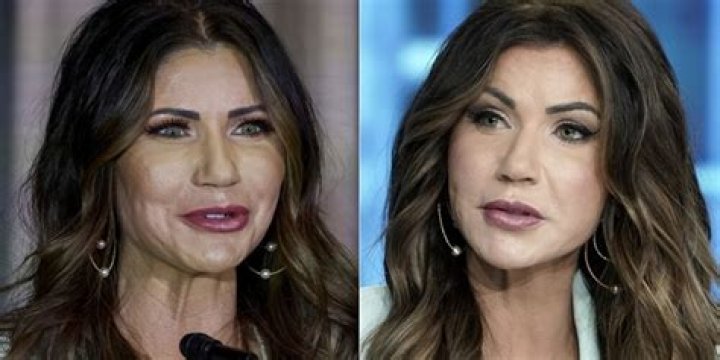 Kristi Noem's Plastic Surgery: Before And After Photos