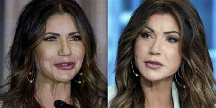 Kristie Noem's Plastic Surgery: Before And After