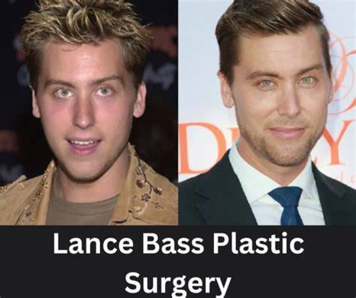Lance Bass Plastic Surgery: All The Details, Before And After