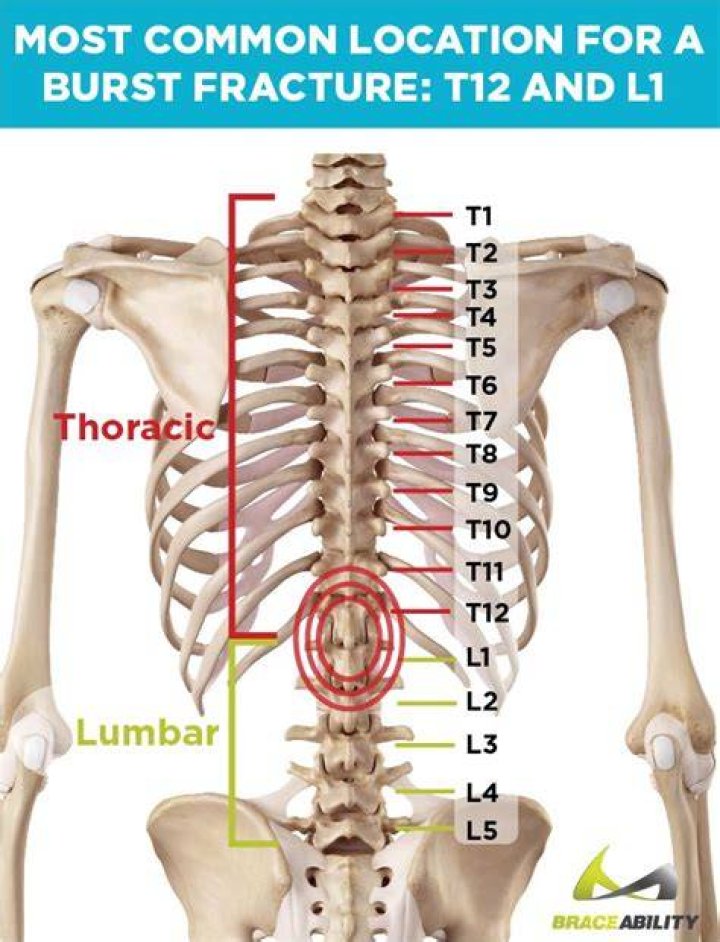 [Location] T12 Vertebra Fracture: Causes, Symptoms, And Treatment Options