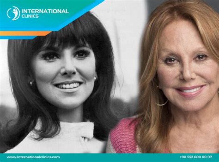 Marlo Thomas Nose Job: Truth Unveiled