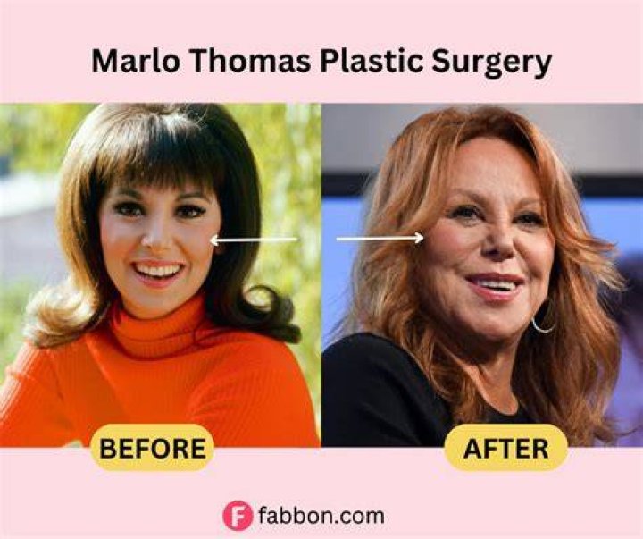 Marlo Thomas On Botox: The Surprising Benefits And Risks