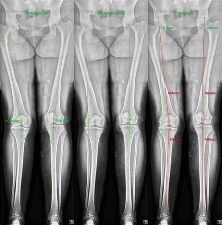 Optimal Leg To Height Ratio: The Ultimate Guide To Body Proportions