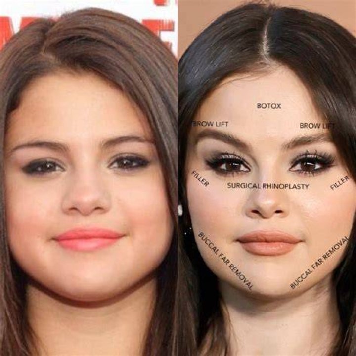 Selena Gomez's Plastic Surgery: Unveiling Hidden Truths And Expert Perspectives