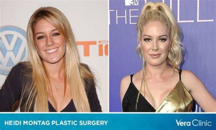 Striking Transformation: Heidi Montag's Surgery Journey