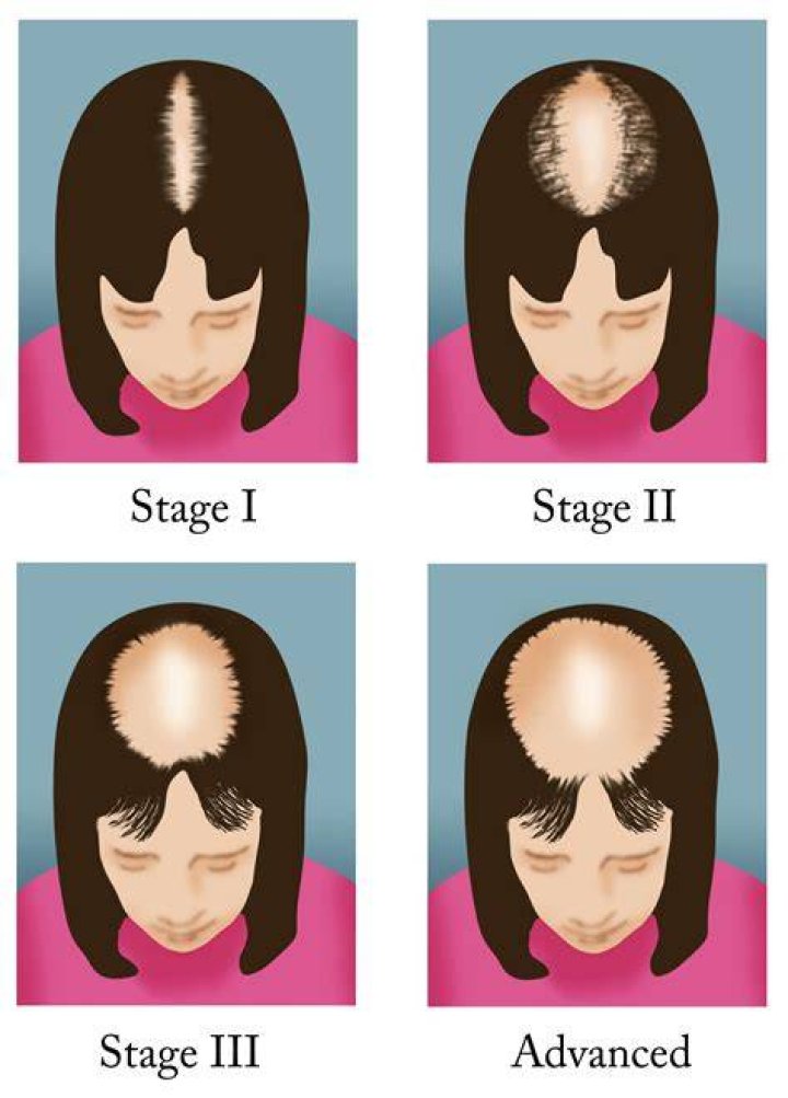 The Shining Scalps: Balding Rappers Take Center Stage