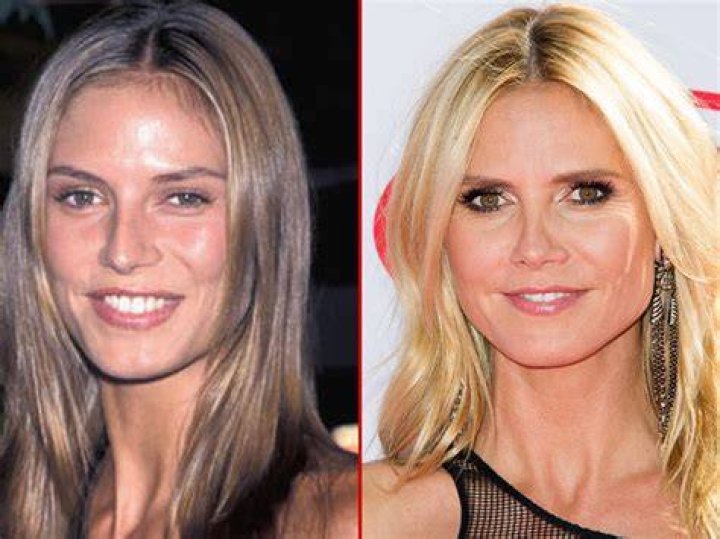 The Transformation Of Heidi: Before And After Plastic Surgery
