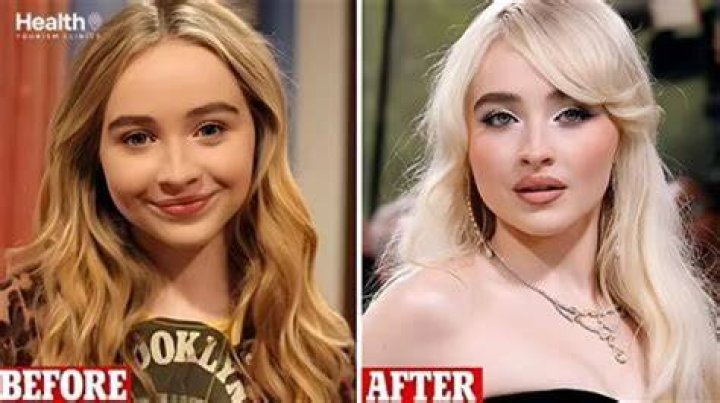 The Transformation Of Sabrina Carpenter: Before And After Fillers Revealed
