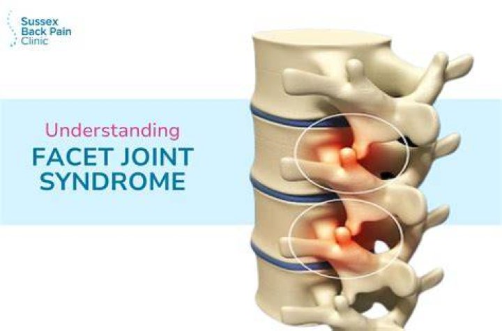 The Ultimate Guide To Facet Arthropathy: Definition, Symptoms, And Treatment