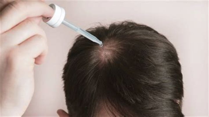The Ultimate Guide To Gasly Hairlines: Causes, Treatments, And Prevention