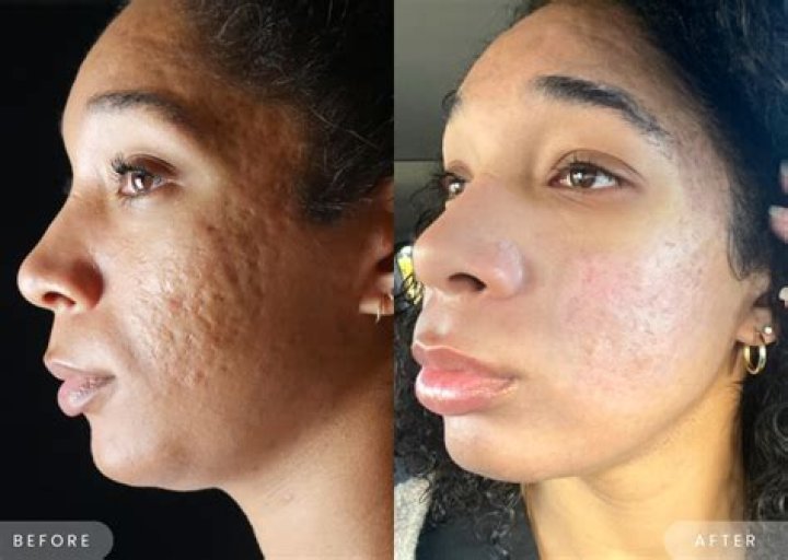 The Ultimate Guide To Healing Seals Scars On Face
