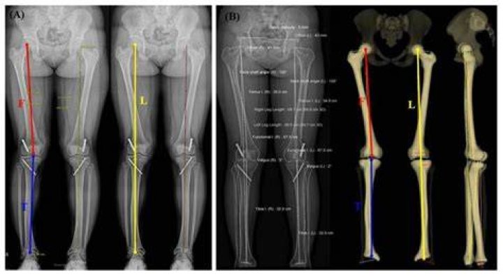 The Ultimate Guide To Understanding Upper Leg-to-Lower Leg Length Ratio