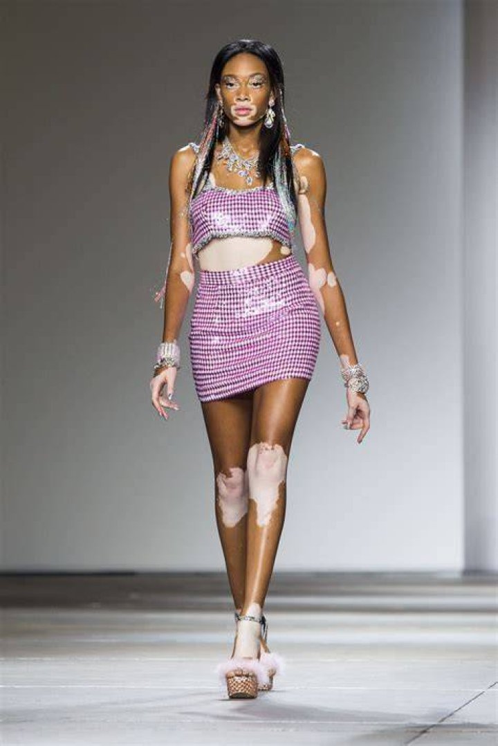 Top Vitiligo Model [vitiligo Model Name] | Inspiring Beauty