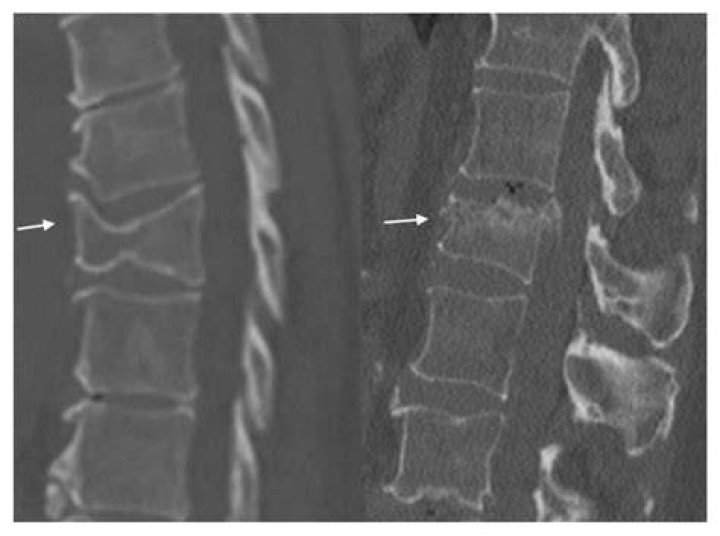 Ultimate Guide To Understanding T12 Fractures