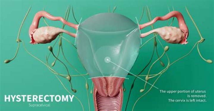 Uncovering Kate's Hysterectomy: Unveiling Medical Mysteries