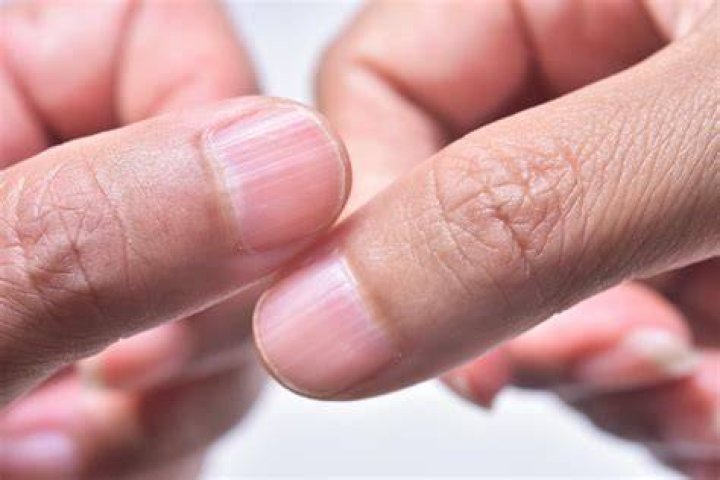 Uncovering The Meaning Of Horizontal Ridges On Finger Nails