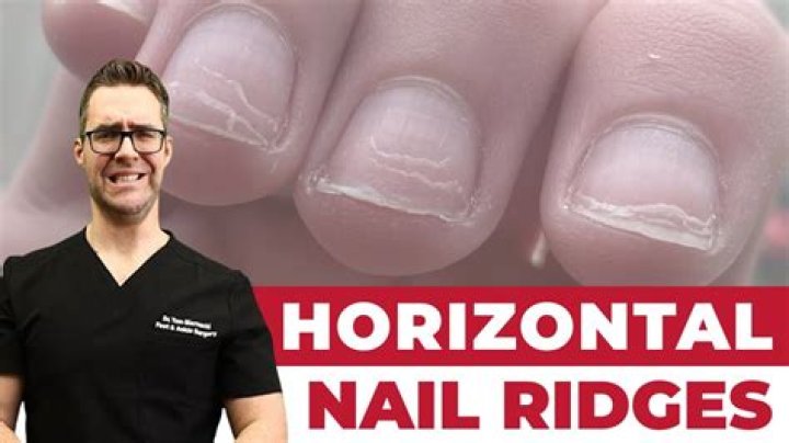 Uncovering The Secrets: Horizontal Ridges In Fingernails Unveiled