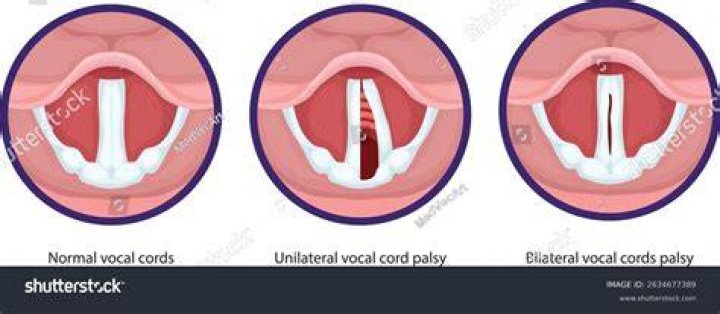 Understanding Kerry Kennedy's Vocal Condition: A Comprehensive Analysis
