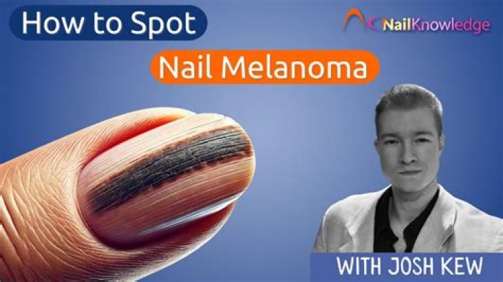 Unveiling Kardashian Melanoma: Discoveries And Insights