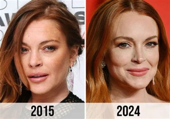 Unveiling Lindsay Lohan's Journey With Botox: Discoveries And Insights