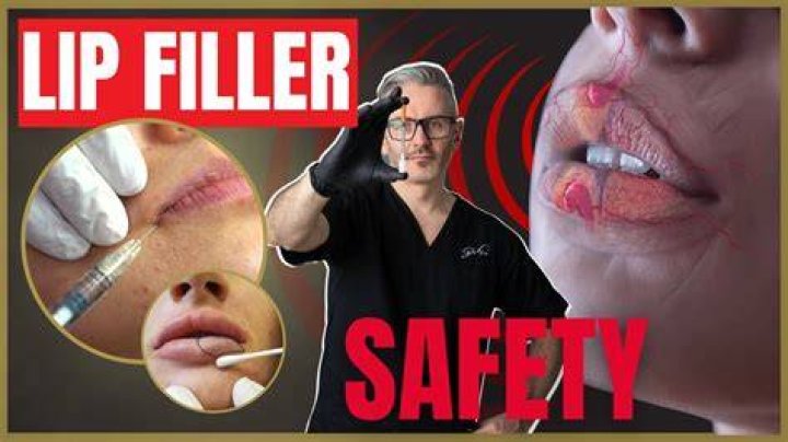Unveiling The Dangers Of "Too Much Lip Filler": Risks, Consequences, And Prevention