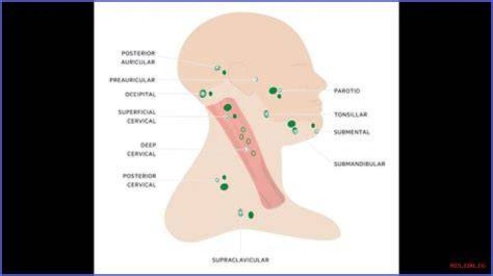 Virchow Node: A Comprehensive Guide To Its Significance In Pathology