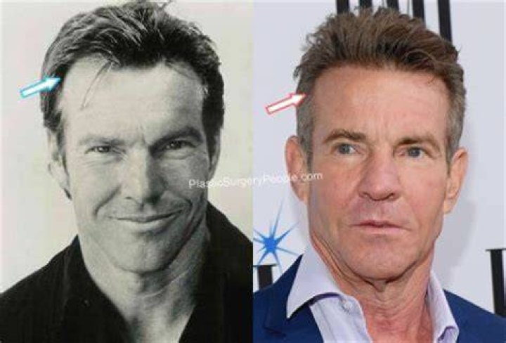 What's Behind Dennis Quaid's Face Transformation?