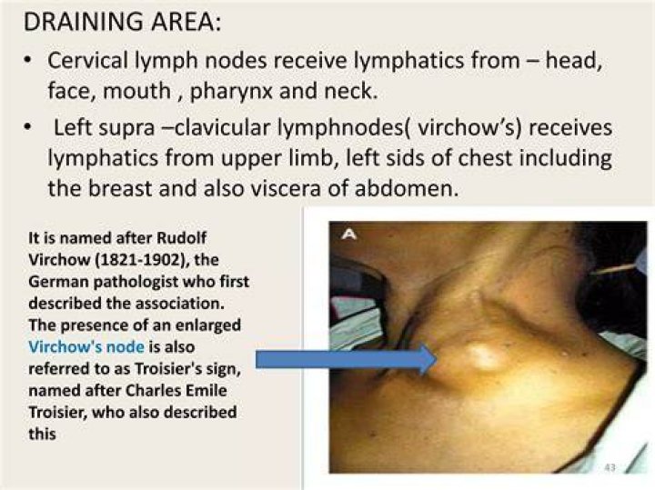 What You Need To Know About Swollen Virchow's Nodes