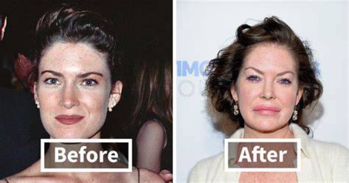 Who Bears The Financial Burden: Surgeries On Botched